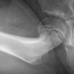 Fig. 1-B A lateral radiograph of the right hip showing an anterior slip of the right capital femoral epiphysis.

