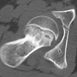 Fig. 2-A A computed tomography scan of the right hip demonstrating anterior displacement of the femoral head.
