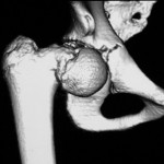 Fig. 2-B A three-dimensional computed tomography reconstruction of the right hip demonstrating anterior displacement of the femoral head.
