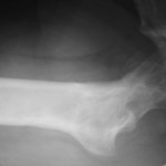 Fig. 4-B Thirty months after the operation, a lateral radiograph of the right hip reveals a normal joint space and a congruous femoral head. There is no evidence of osteonecrosis of the femoral head.
