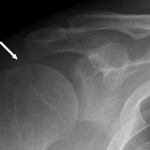 Fig. 1 An anteroposterior radiograph of the shoulder, showing a faint amorphous opacity (arrow) above the humeral head.
