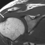 Fig. 2-A Oblique coronal T1-weighted magnetic resonance image of the shoulder (repetition time, 475 msec; echo time, 12 msec), demonstrating an amorphous deposit of low signal intensity (arrow) at the articular side of the supraspinatus tendon.
