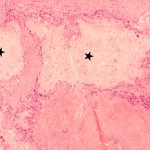 Fig. 4 Photomicrograph of a tissue specimen from the shoulder, demonstrating amorphous tophaceous deposits (stars) surrounded by granulomatous infiltrates consisting of multinucleated giant cells and histiocytes (hematoxylin and eosin; original magnification, ×40).
