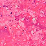 Fig. 3 Histologic slide of the core-needle biopsy prior to chemotherapy, showing grade-4 osteoblastic osteosarcoma (hematoxylin and eosin stain, ×40).
