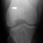 Fig. 1-A Preoperative anteroposterior radiograph showing the medial femoral condylar fracture (arrows).
