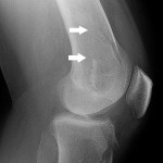 Fig. 1-B Preoperative lateral radiograph showing the medial femoral condylar fracture (arrows).
