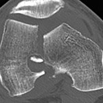 Fig. 2 Computed tomography scan demonstrating the displaced medial femoral condylar fracture through the femoral bone tunnel.

