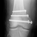 Fig. 4-A Postoperative anteroposterior radiograph showing the knee after arthroscopic reduction and percutaneous fixation.
