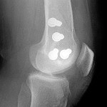 Fig. 4-B Postoperative lateral radiograph showing the knee after arthroscopic reduction and percutaneous fixation.
