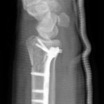 Fig. 2 Lateral radiograph showing the locking plate in position on the distal and volar aspect of the radius, with retained angled drill guides evident. 
