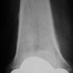 Fig. 1 Anteroposterior radiograph of the right knee, made at six years, shows periosteal elevation of the distal part of the femur.
