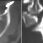 Fig. 1-A Axial and coronal computed tomography scans of the patient, showing the osteolytic lesion in the left lateral mass of the atlas.
