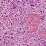 Fig. 3 Photomicrograph of the biopsy specimen, showing spindle-shaped malignant cells with fibrogenic activity. An osseous matrix is seen focally (hematoxylin and eosin; original magnification, ×100).
