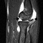 Fig. 1-A Weighted magnetic resonance images of the left elbow. Sagittal view showing a joint effusion, an osteochondral defect in the capitellum anteriorly (arrow), and a capitellar fracture fragment posteriorly (arrowhead).
