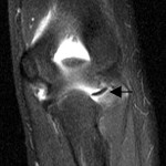Fig. 1-B Weighted magnetic resonance images of the left elbow. Posterior coronal view showing the capitellar fracture fragment located in the posterolateral gutter of the elbow (arrow). Note the size of the fragment, which contains only minimal subchondral bone.
