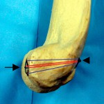 Fig. 2-B The suture fixation technique is illustrated on an elbow model.  A smooth Keith needle was used to pass the suture from the anterior aspect of the capitellum to a posterior, nonarticular portion of the elbow. This was performed by drilling four distinct holes with the Keith needle to pass the two separate sutures (red line indicates suture #1, and blue line indicates suture #2). Sutures were passed through the edge of the osteochondral fracture fragment (arrow), across the capitellar defect, and out the back of the humerus, where they were tied securely over a cortical bridge (arrowhead). Care was taken to retrieve the needle and tie the suture with minimal dissection of the soft-tissue sleeve that surrounds the posterior aspect of the lateral condyle. The suture was appropriately tensioned and the elbow was taken through a full range of motion to ensure stability of the fixation.
