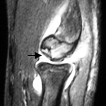 Fig. 3 Sagittal T2-weighted magnetic resonance imaging scan, acquired three months after fracture fixation, demonstrating restoration of the contour of the capitellar articular surface, healing of the osteochondral fracture fragment (arrow), and maintenance of the open physes.
