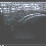 Fig. 3 An ultrasound scan of the knee, showing a sleeve fracture of the superior pole of the patella. The fracture gap is 2 mm in width.

