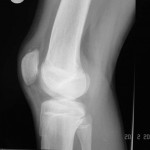 Fig. 4-A Lateral (Fig. 4-A) and skyline (Fig. 4-B) radiographs showing the healed sleeve fracture at ten weeks after the injury.
