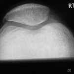 Fig. 4-B Lateral (Fig. 4-A) and skyline (Fig. 4-B) radiographs showing the healed sleeve fracture at ten weeks after the injury.
