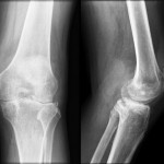 Fig. 1 Anteroposterior (left) and lateral (right) radiographs of the left knee in July 2004. Tricompartmental degenerative joint disease is evident, with mild erosive changes thought to be consistent with chronic gouty arthritis.
