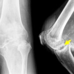 Fig. 2 Anteroposterior (left) and lateral (right) radiographs of the left knee in November 2004, showing increased soft-tissue edema and calcifications (white arrows), global osteopenia, subchondral erosion (yellow arrow), and advanced joint destruction secondary to tuberculous infection.
