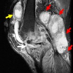 Fig. 3 Sagittal T2-weighted magnetic resonance image of the left knee in November 2004, showing advanced active tuberculosis of the knee with hypertrophic synovitis, destruction of the articular surfaces (white arrow), obliteration of the cruciate ligaments, multiple periarticular fluid collections (yellow arrow), and posterior joint capsule distension with a lobulated periarticular mass measuring 6.4 × 5.8 × 6.4 cm (red arrows).
