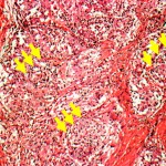 Fig. 4 Photomicrograph of synovial tissue from the posterior part of the left knee in January 2005, revealing granulomatous synovitis (yellow arrows) typical of tuberculosis (hematoxylin and eosin, ×100).
