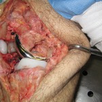 Fig. 3 Macroscopic examination at autopsy showed metastatic cholangiocarcinoma in the distal portion of the femur behind the medial portion of the prosthetic implant.
