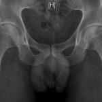 Fig. 1 Anteroposterior radiograph of the pelvis, demonstrating a left anterolateral acetabular osseous fragment. There is a positive crossover sign, and the center-edge angle of Wiberg is 50° and 18°, respectively, when measured first lateral and then medial to the osseous fragment.
