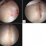 Fig. 4 Intraoperative arthroscopic images (A, B, and C). Acetabular, chondromalacia (A) is demonstrated at the rim fracture. Debridement and chondroplasty of the damaged articular surface (B) was performed, and the post-reduction image (C) demonstrates near-anatomic reduction.

