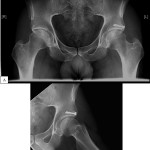Fig. 6 One-year follow-up anteroposterior pelvic (A) and frog-leg lateral (B) radiographs demonstrating a united lateral osseous fragment. The position and alignment of the hardware is unchanged.
