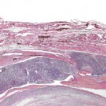 Fig. 3 Photomicrograph showing lobulated, cellular neoplasm exhibiting infiltration into surrounding fibrous connective tissue and skeletal muscle (hematoxylin and eosin, ×20).
