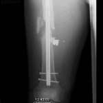 Fig. 1-A Anteroposterior immediate postoperative radiograph showing the right thigh after intramedullary nail fixation of the femoral fracture.
