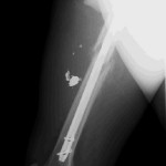 Fig. 1-B Lateral immediate postoperative radiograph showing the right thigh after intramedullary nail fixation of the femoral fracture.

