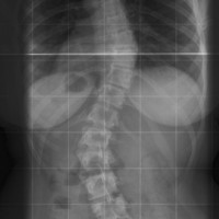 Upper-Extremity Neurovascular Compromise During Posterior Spinal Fusion ...