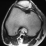 Fig. 2 T1-weighted magnetic resonance imaging scan of the right knee, showing an osteochondral defect at the donor site, over the medial aspect of the femoral trochlea.
