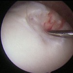 Fig. 3 At arthroscopy, a soft lesion in the medial aspect of the right trochlea, corresponding to the previous donor site, was detected. The lesion was palpated with a probe, and it started to bleed.
