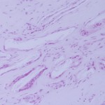 Fig. 4 Biopsy of the lesion (hematoxylin and eosin, original magnification, ×150).
