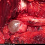 Fig. 2 Intraoperative photograph demonstrating the cyst (arrowheads) that was compressing the sciatic nerve (arrow). (With permission of the Cardiff and Wales NHS Trust.)
