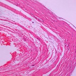 Fig. 3 Histological section of the fibrous-walled cyst (hematoxylin and eosin, ×500). There is no identifiable synovial lining.
