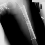 Fig. 1-B Postoperative anteroposterior radiograph demonstrating plate osteosynthesis of the left femur.
