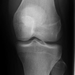 Fig. 1 A radiograph of the knee made one year prior to presentation for anterior knee pain shows a normal patella.
