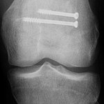 Fig. 4 Anteroposterior radiograph made eighteen months after the first magnetic resonance imaging study and six months after the repeat open reduction with screw fixation. The longitudinal fracture line is no longer visible.
