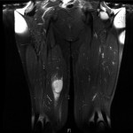 Fig. 2 Coronal T2-weighted magnetic resonance image depicts a 5.0 × 3.8 × 4.3-cm high intensity lesion within the medial compartment of the thigh.
