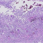 Fig. 3 A low-power hematoxylin and eosin-stained section illustrating a florid granulomatous response with scattered multinucleated giant cells.
