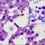 Fig. 4 High-magnification hematoxylin and eosin-stained section. Note inset mucicarmine stain illustrating a thick capsule (×350).
