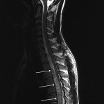 Fig. 1 T2-weighted sagittal magnetic resonance image demonstrating a lesion extending from C2 to L3. A mass effect and spinal cord compression can be seen in the cervical and thoracic levels (arrows).
