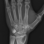 Fig. 1-A Anteroposterior radiograph showing a radiolucent lesion in the lateral aspect of the distal radial epiphysis of a thirty-three-year-old man.

