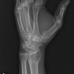 Fig. 1-C Oblique radiograph showing a radiolucent lesion in the lateral aspect of the distal radial epiphysis of a thirty-three-year-old man.
